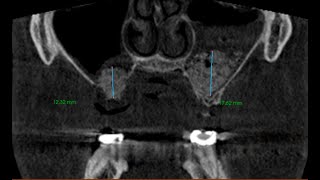 Sinus Lift Augmenation  Lateral Wall Approach  A Debrief [upl. by Anauqaj856]