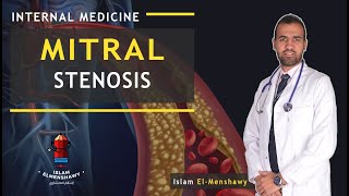 Mitral Stenosis  MS [upl. by Thorn638]