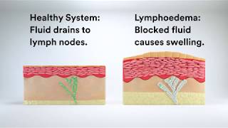 Managing Lymphoedema with Compression Therapy [upl. by Esor]