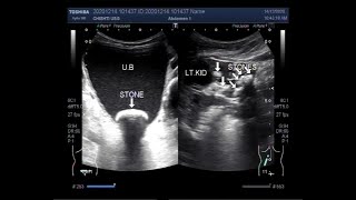 Ultrasound Video showing Pyonephrosis with multiple renal stones and a large vesical stone [upl. by Aihsenrad]