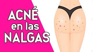 HAZ ESTO PARA NO TENER GRANOS EN LAS NALGAS 2018 [upl. by Klos]