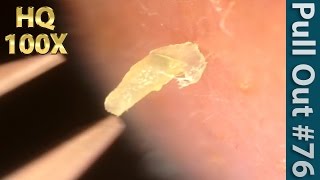 76 Pull Out Blackheads Close up 100X  Blackheads Removal  ピンセットで角栓を抜く [upl. by Delphinia507]