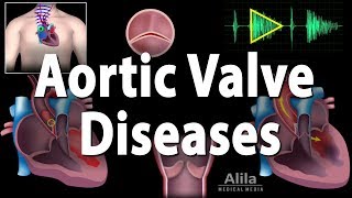 Aortic Valve Disease Animation [upl. by Atiz822]