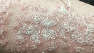 DENTAL PICK vs PSORIASIS FLAKES [upl. by Ojahtnamas]