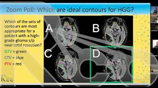 Session 9 CNS High Grade Glioma Hypofractionation [upl. by Ydnac257]