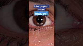 Dry Eye Syndrome 4 symptoms  dryeye [upl. by Lundt684]