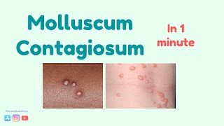 Molluscum Contagiosum Causes symptoms and treatment [upl. by Ahsinroc]