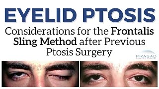 Eyelid Ptosis  Why Frontalis Sling Should be Carefully Considered after Previous Surgeries [upl. by Jacob]