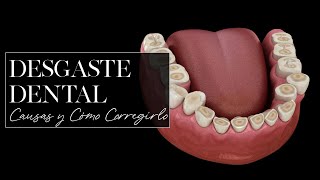 Desgaste Dental causas y cómo corregirlo [upl. by Harry]