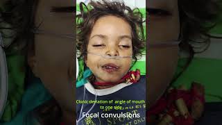 Focal Convulsions  Focal Seizures in a child [upl. by Yenobe]