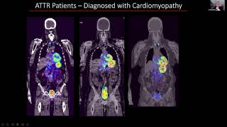 ATTR Amyloid Imaging Update [upl. by Rudy]