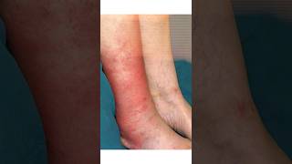 How to Treat Cellulitis mumbai shortsfeed2024 vascularhealth shortsvideo [upl. by Jeanie]