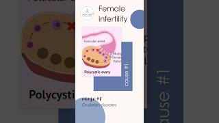 Female Infertility Cause 1 Ovulation disorders [upl. by Ovid]