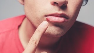 Dermatologist explains causes of cold sores [upl. by Ajup28]