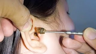 Removing One HUGE EARWAX Stuck in Womans Ear [upl. by Arreyt]