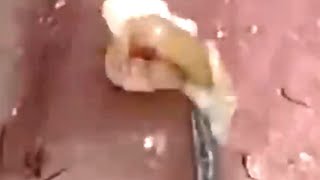 Deep blackhead extraction Cystic acne amp pimple popping 35 [upl. by Elleinwad]