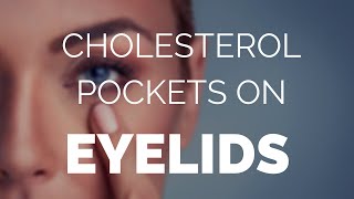 Cholesterol pockets on eyelids help and advice on Cholesterol pockets [upl. by Ellerad]