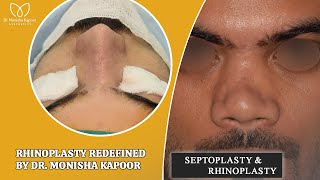 Complicated Revision Rhinoplasty Case Performed by Dr Monisha Kapoor explore result vlog [upl. by Anali]