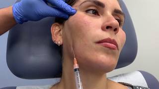 Sculptra treatment for correcting facial volume loss and antiaging by Dr Shaun Patel in Miami FL [upl. by Odnamra195]