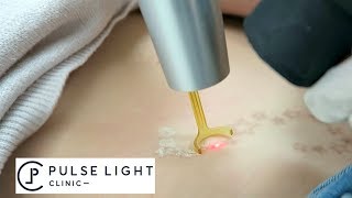 The TRUTH About Tattoo Removal My Experience  Tips  Pulse Light Clinic [upl. by Noret]