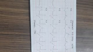 LEARN ECG VENTRICULAR BIGEMINY WITH RBBB IN 2 MINUTES [upl. by Weyermann]