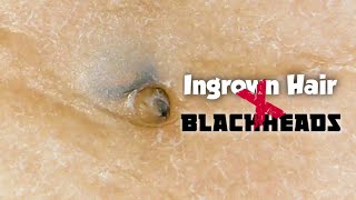 Ingrown hair removal [upl. by Porta]