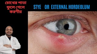 Stye  Chalazion  Treatment of external hordeolum  অঞ্জনি কি কেন হয় চিকিৎসা ও করণীয় কি [upl. by Ludovick263]