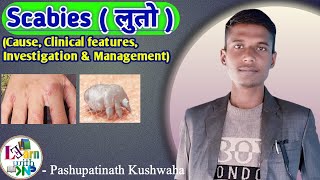 Scabies  लुतो   Skin disease  Treatment of scabies  healthloksewa scabies [upl. by Eilyak]