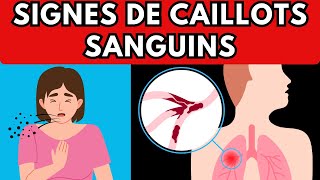 9 SIGNES DALERTE DE CAILLOTS SANGUINS  Santé Intégrale [upl. by Southworth572]