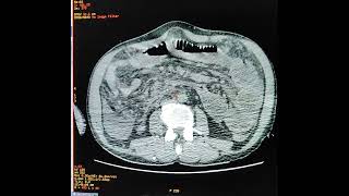 Right ingunal hernia with Paraumbilical hernia with small bowel obstruction [upl. by Aihsenek]