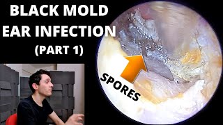 Black Mold Ear Infection Cleaned Part 1 [upl. by Asiel]