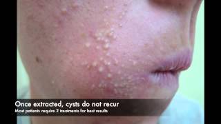 Acne cyst laser treatment [upl. by Redienhcs]