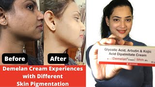 Demelan Cream Experiences with Different Skin Pigmentation  Demelan cream before and after pictures [upl. by Ariaek875]