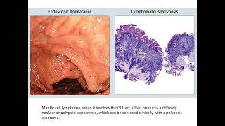 Gastrointestinal Pathology Case Review [upl. by Ennaisoj812]