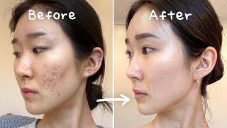 3 Secrets to Clearing Acne Without Medication No Accutane  Tretinoin [upl. by Alleusnoc335]