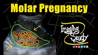 Molar Pregnancy  Hydatidiform Mole  Ultrasound  Case 281 [upl. by Eenwat]