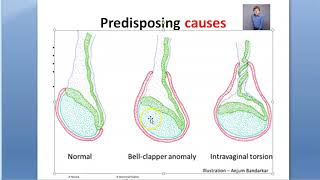 Surgery Torsion testis Bell Clapper deformity Deming Prehn Angeli sign [upl. by Aidnyc]