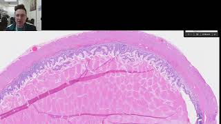 Appendiceal Mucocele vs Lowgrade appendiceal mucinous neoplasm LAMN [upl. by Revolc]