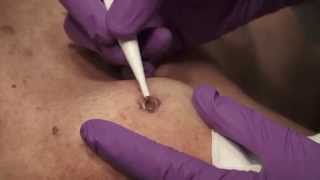 Watch amp Learn Electrosurgery [upl. by Audre]