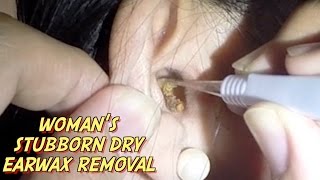 Womans Stubborn Dry Earwax Removal [upl. by Hazlip]