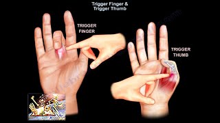 Trigger Finger amp Trigger Thumb  Everything You Need To Know  Dr Nabil Ebraheim [upl. by Ong645]