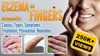 Eczema on Fingers Causes Types Symptoms Treatment and Remedies  Small Blisters and How To Treat [upl. by Yllac]