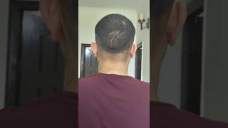 First HairCut After Hair Transplant  Donor area besthairtransplant qht [upl. by Mirna]