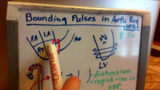 Bounding Pulses in Aortic Regurgitation [upl. by Wenz]