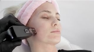 Morpheus8 Face Treatment amp Microneedling Procedure  Vitalyc Medspa Dallas TX [upl. by Aivonas408]