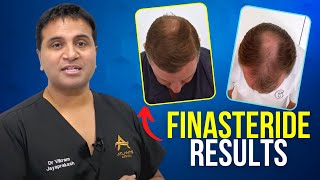 Finasteride vs No Treatment Comparison on Identical Twins [upl. by Trudey]