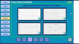 Focal EEG Abnormalities 2 [upl. by Iclehc]