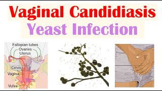 Vaginal Candidiasis “Yeast Infection” Causes Risk Factors Signs amp Symptoms Diagnosis Treatment [upl. by Suckow699]