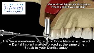 Sinus Lift  Crestal Sinus Lift to Graft Bone for Dental Implant Placement [upl. by Retsbew]