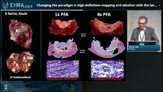 EHRA Congress 2024 Highdefinition mapping and ablation [upl. by Nailliw]